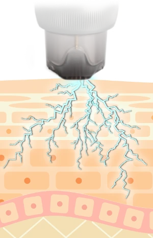 Microneedling