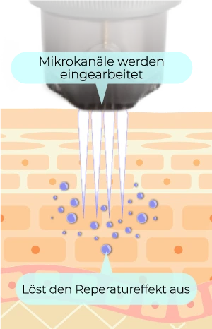 Microneedling