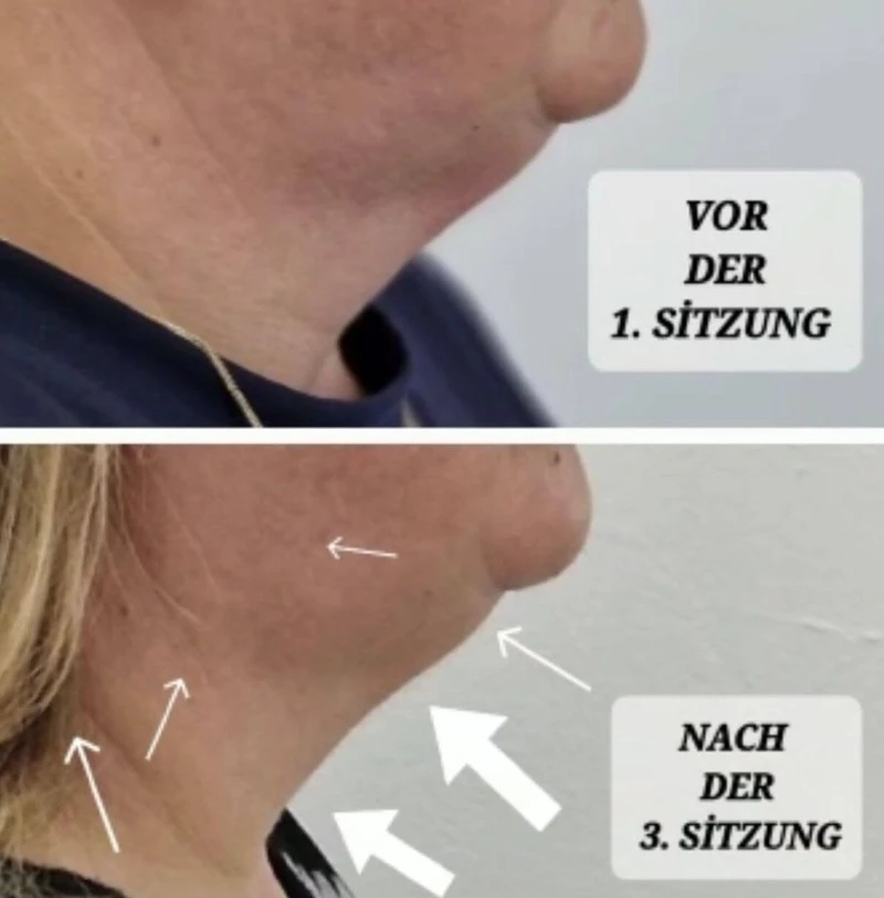 Before After pictures