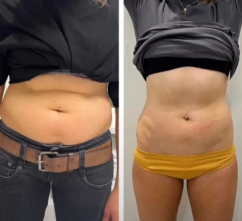 Before After Pictures