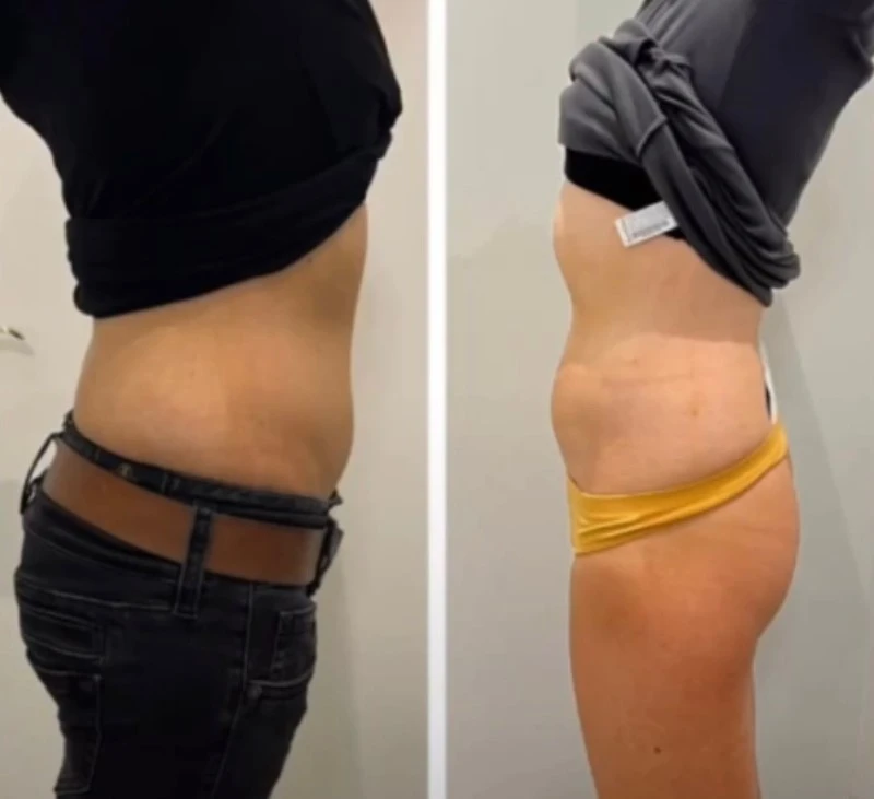 Before After Pictures