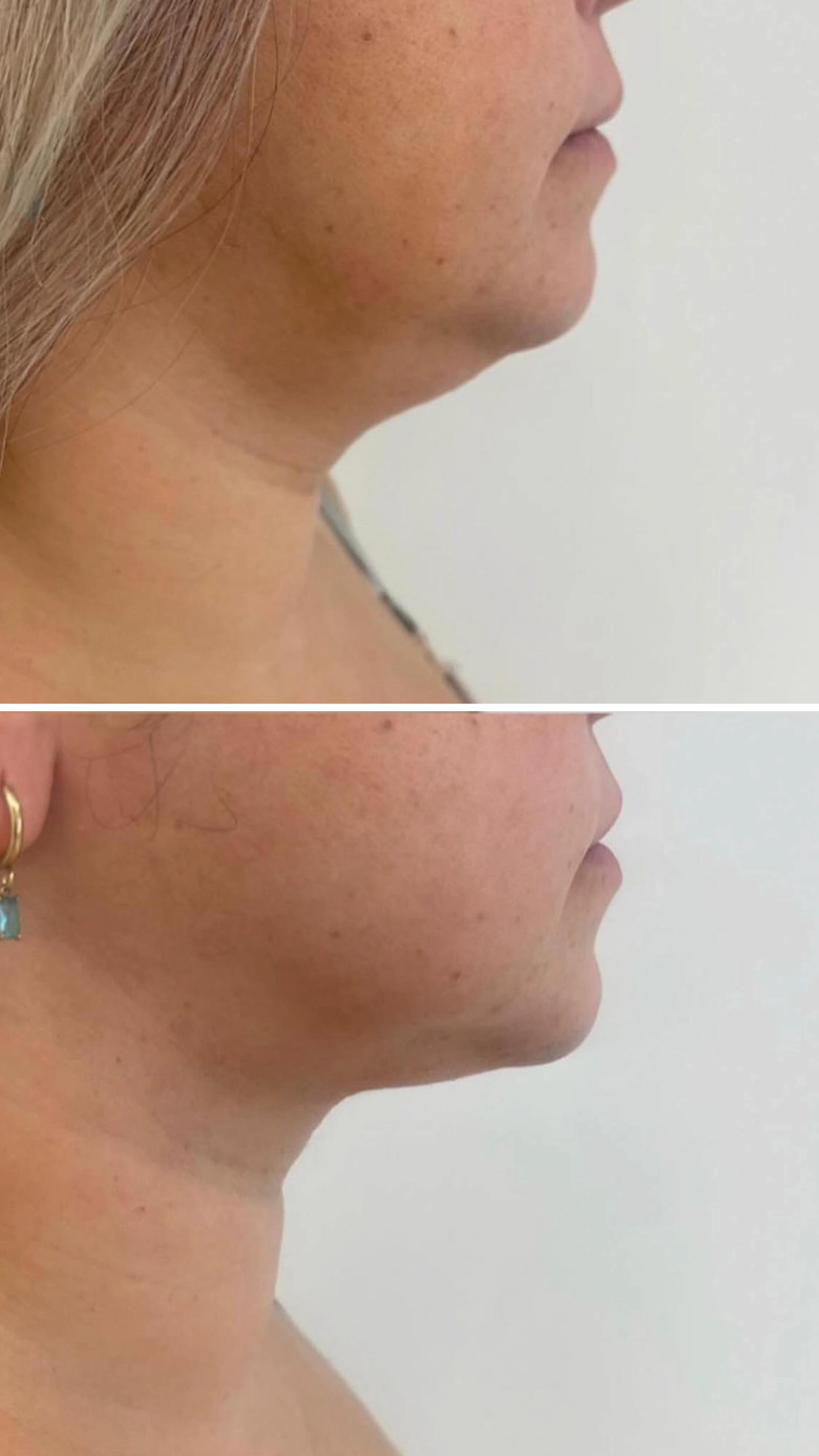 Before After Pictures